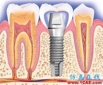ansys对种植牙的仿真模拟ansys仿真分析图片2