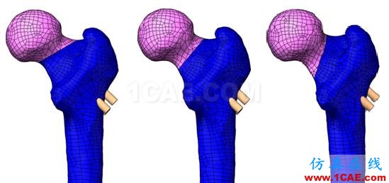 “倒品字”与“品字”空心钉不同Pauwels分型骨折的生物力学性能研讨ansys仿真分析图片3
