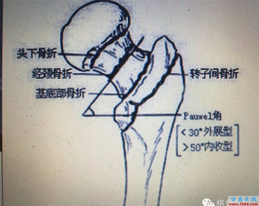 “倒品字”与“品字”空心钉不同Pauwels分型骨折的生物力学性能研讨ansys仿真分析图片2